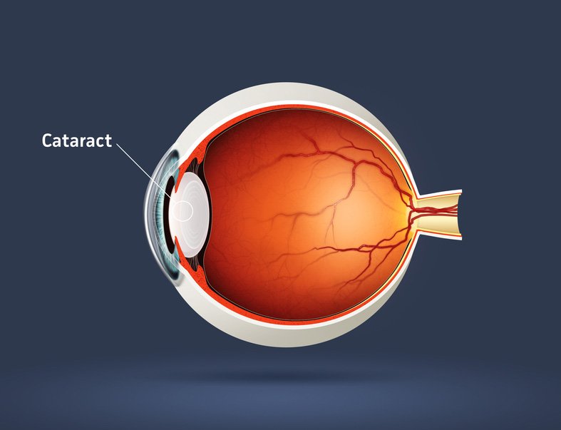 Cataract Treatment & Surgery