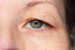 Eyelid Problems Examination