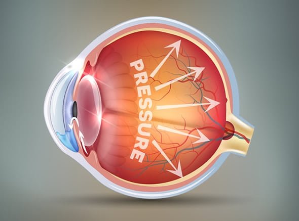 Glaucoma Diagnosis & Treatment