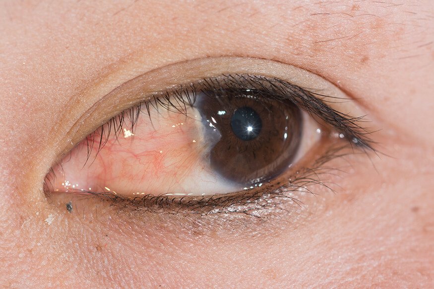 Pterygium Examination