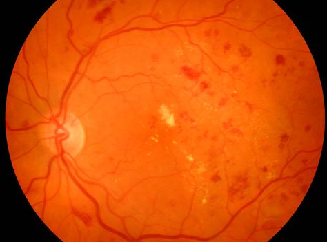 Retina & Diabetic Eye Care